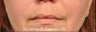 Lip Augmentation