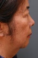 Female Chin Implant 