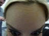 Botox