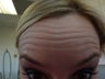 Botox