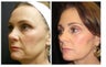 Ultherapy 