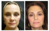 Ultherapy 