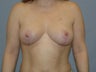 Breast Lift