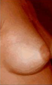 Breast Augmentation