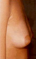 Breast Augmentation