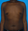 Gynecomastia 