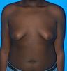 Gynecomastia 