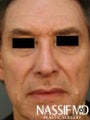 Male Revision Rhinoplasty 