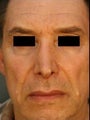 Male Revision Rhinoplasty 