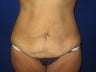 Tummy Tuck