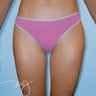 Thigh Liposuction 