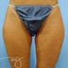 Thigh Liposuction 