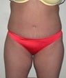44 year old female patient 