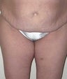44 year old female patient 