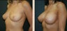 Breast Augmentation
