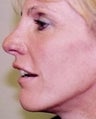 42 year old female patient 