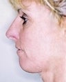 42 year old female patient 