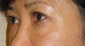 Restylane 