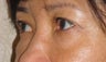 Restylane 