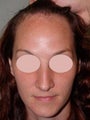 Female Hairline Advancement