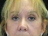 Eyelid Surgery