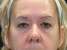 Eyelid Surgery