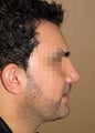 Chin liposuction, china augmentation, rhinoplasty