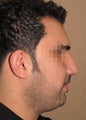 Chin liposuction, china augmentation, rhinoplasty