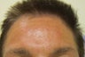 45 year old male injected for forehead lines