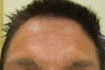 45 year old male injected for forehead lines