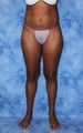 Brazilian Butt Lift and creating curves