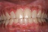 Gum Depigmentation Before and After