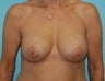 Breast Implant Revision