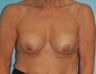 Breast Implant Revision