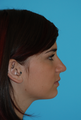 Rhinoplasty