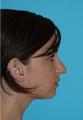 Rhinoplasty