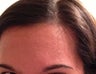 Eyebrow Transplant