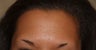 Eyebrow Transplant