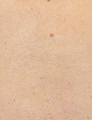 PicoSure Tattoo Removal 