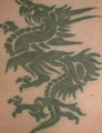 PicoSure Tattoo Removal 