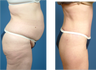 circumferencial Body contouring 