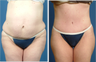 circumferencial Body contouring 