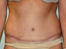 Tummy Tuck
