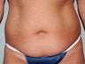 Tummy Tuck
