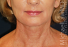 Neck Lift
