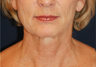 Neck Lift