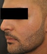 Acne Scarring
