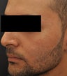 Acne Scarring