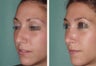 Rhinoplasty