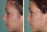 Rhinoplasty
